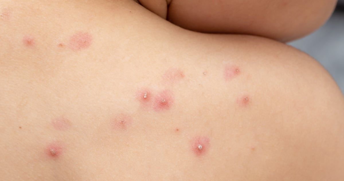 Alarma sanitaria en Argentina