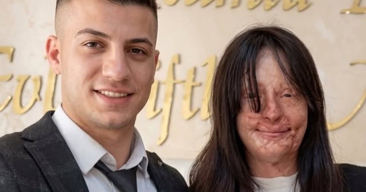 Una mujer se casó con el hombre que le desfiguró la cara con ácido sulfúrico.